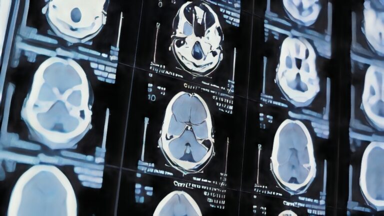 La-forma-del-cerebro-podria-revelar-los-primeros-signos-de-esta-grave-enfermedad